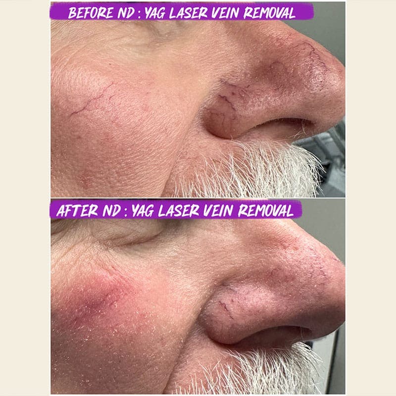 YAG Laser Vein Treatment Before & After Gallery - Patient 297209 - Image 1
