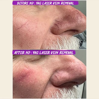 YAG Laser Vein Treatment Before & After Gallery - Patient 297209 - Image 1