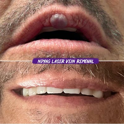 YAG Laser Vein Treatment Before & After Gallery - Patient 820047 - Image 1