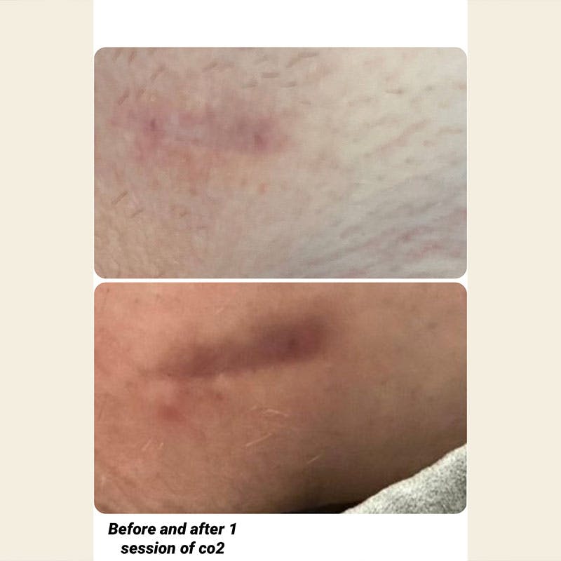 UltraPulse Laser Before & After Gallery - Patient 812275 - Image 1
