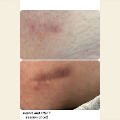 UltraPulse Laser Before & After Gallery - Patient 812275 - Image 1