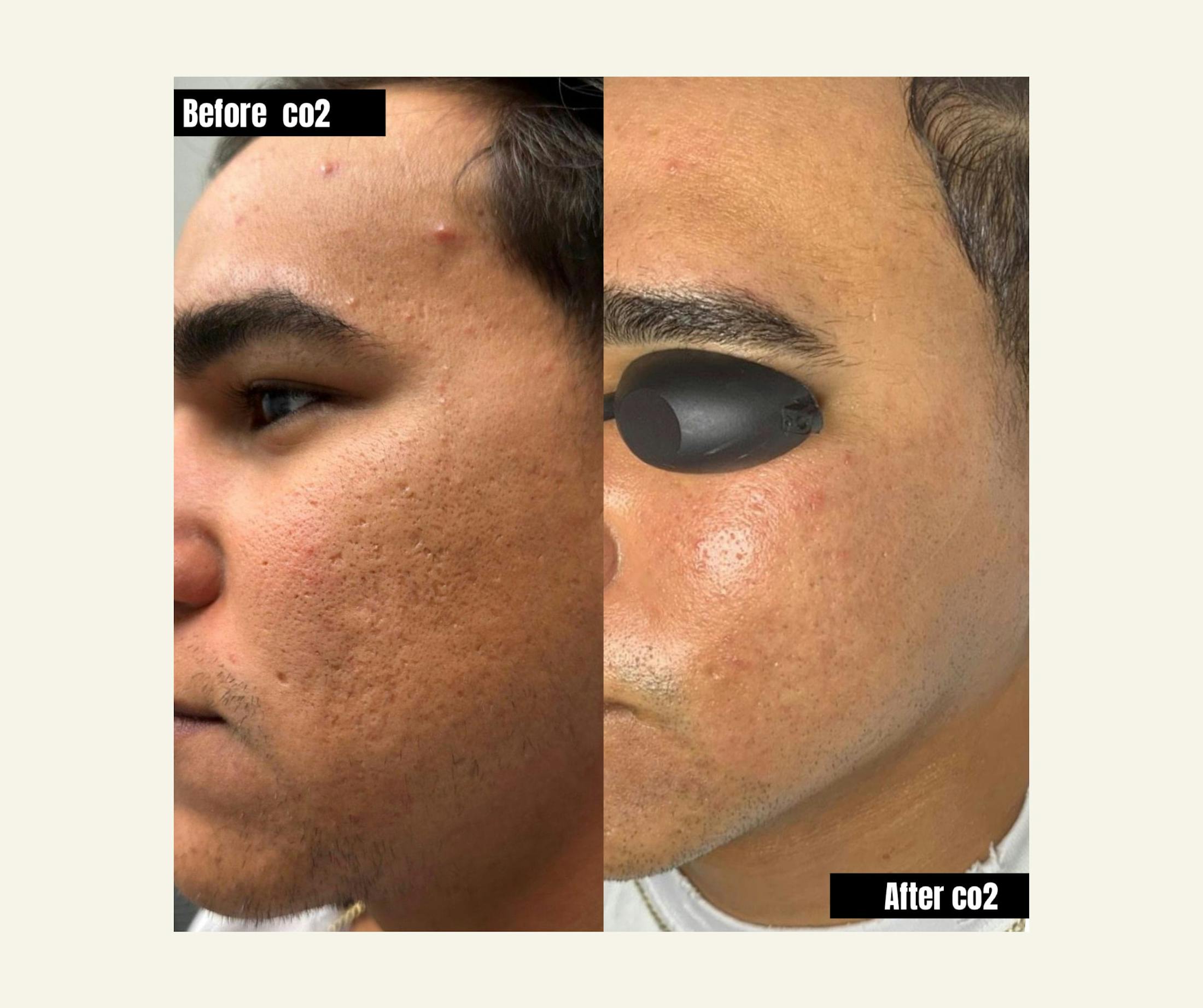 UltraPulse Laser Before & After Gallery - Patient 103199 - Image 1