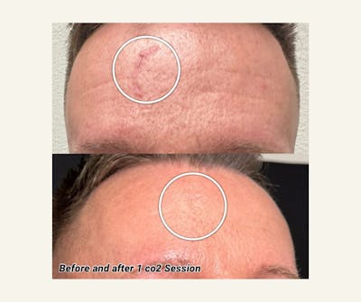 UltraPulse Laser Before & After Gallery - Patient 589871 - Image 1