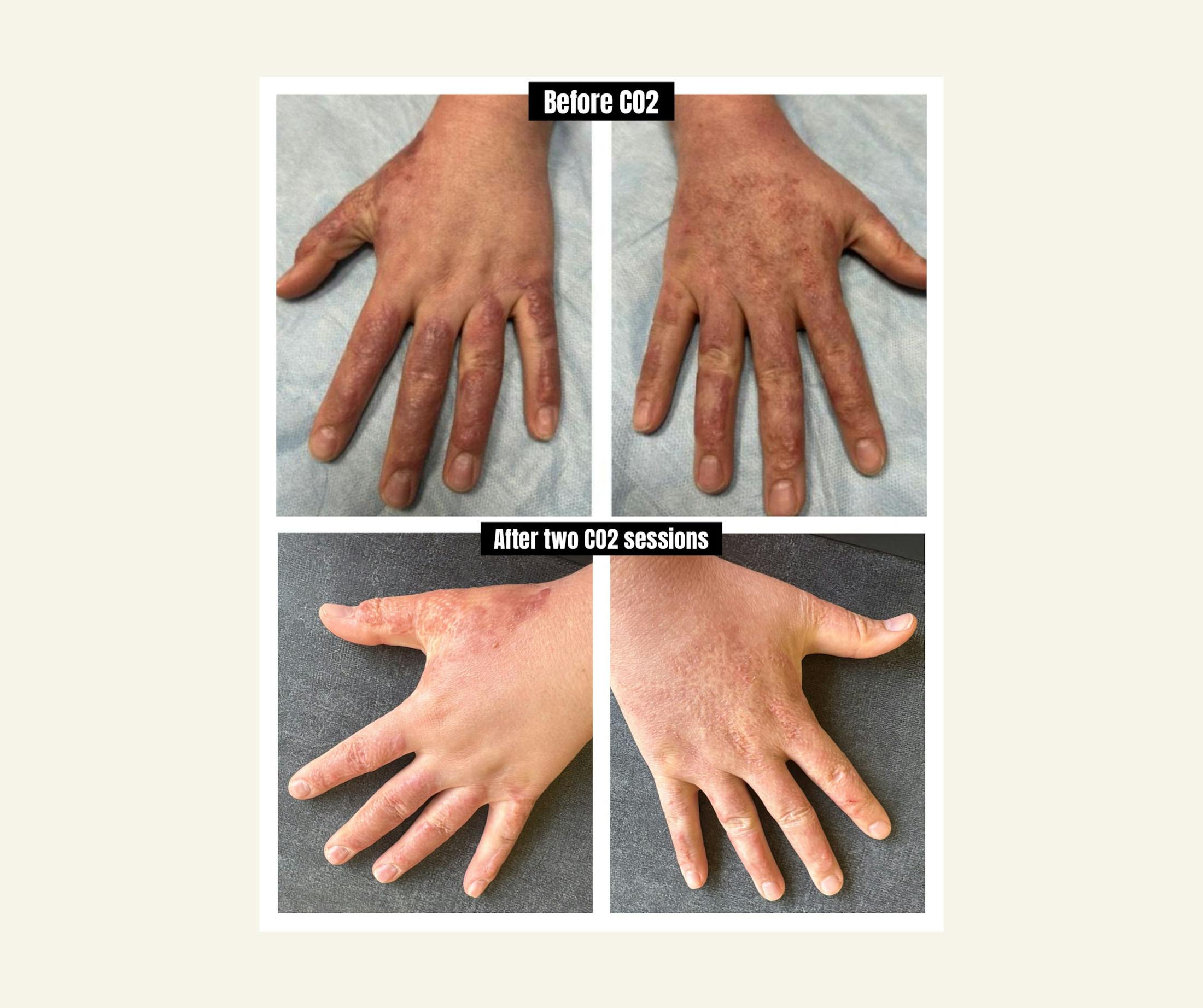 UltraPulse Laser Before & After Gallery - Patient 283946 - Image 1