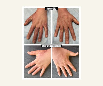 UltraPulse Laser Before & After Gallery - Patient 283946 - Image 1