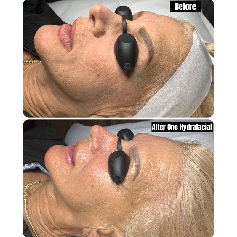 Hydrafacial Syndeo Before & After Gallery - Patient 120981 - Image 1