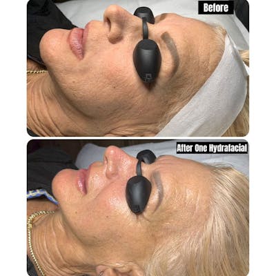 Hydrafacial Syndeo Before & After Gallery - Patient 120981 - Image 1