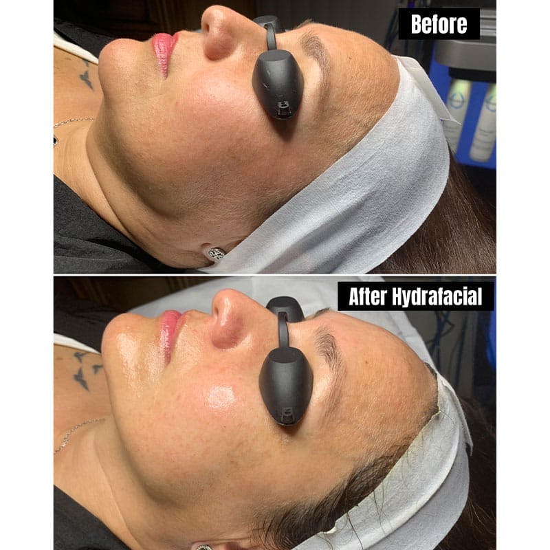Hydrafacial Syndeo Before & After Gallery - Patient 136018 - Image 1