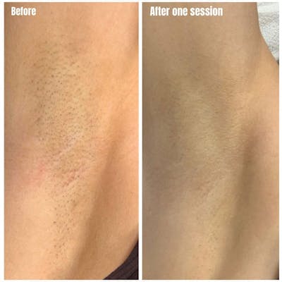 Laser Hair Removal Before & After Gallery - Patient 904140 - Image 1