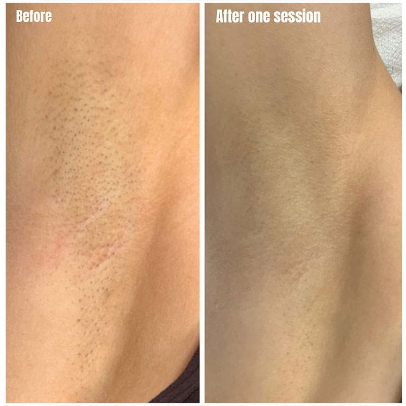 Laser Hair Removal Before & After Gallery - Patient 904140 - Image 1
