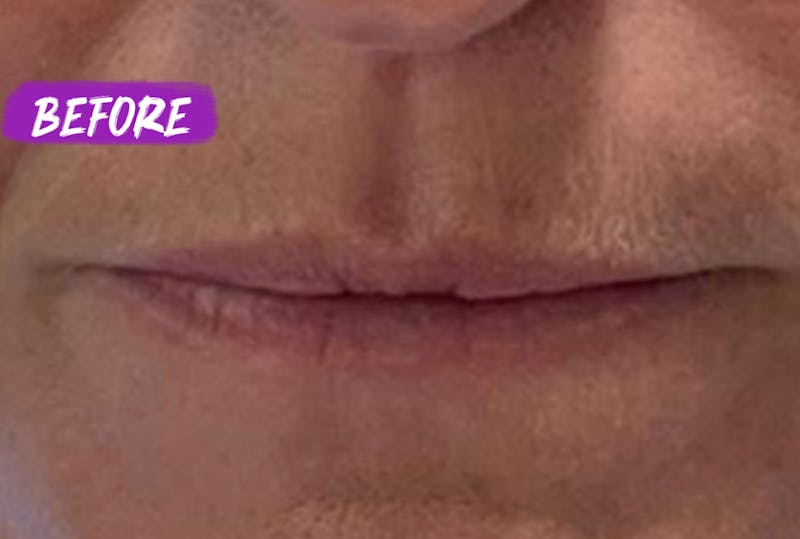 Lip Fillers Before & After Gallery - Patient 840894 - Image 1