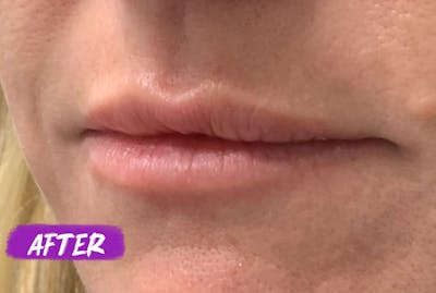 Lip Fillers Before & After Gallery - Patient 840894 - Image 2