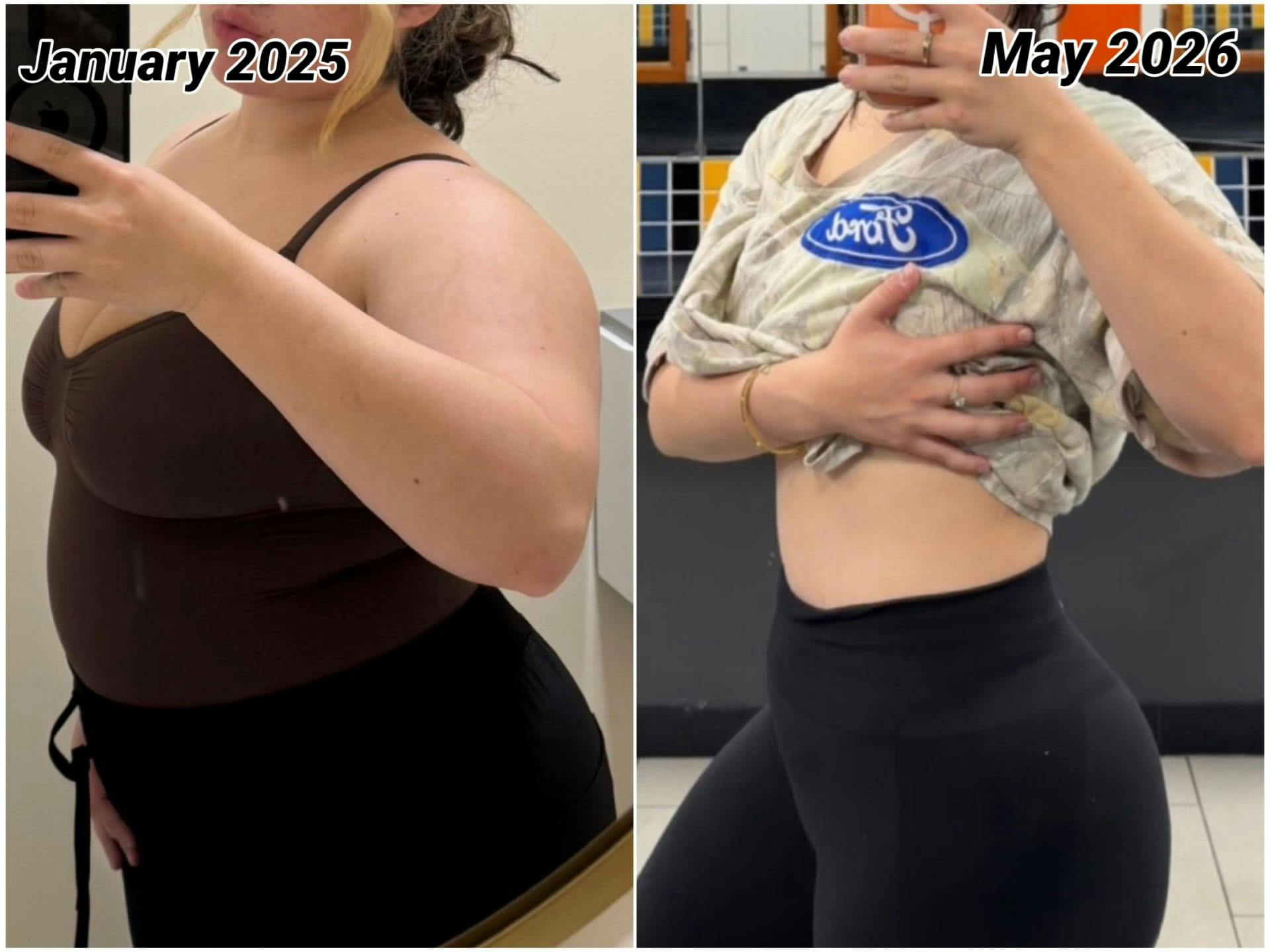 Weight Loss Before & After Gallery - Patient 371417 - Image 1