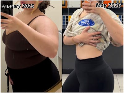 Weight Loss Before & After Gallery - Patient 371417 - Image 1