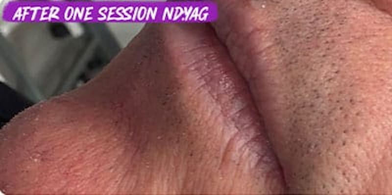 YAG Laser Vein Treatment Before & After Gallery - Patient 415327 - Image 2