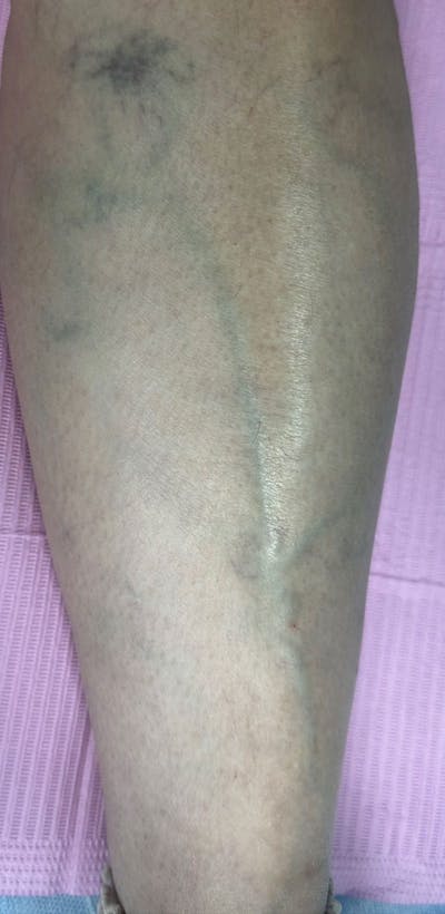 Sclerotherapy & Varithena Before & After Gallery - Patient 363631 - Image 1