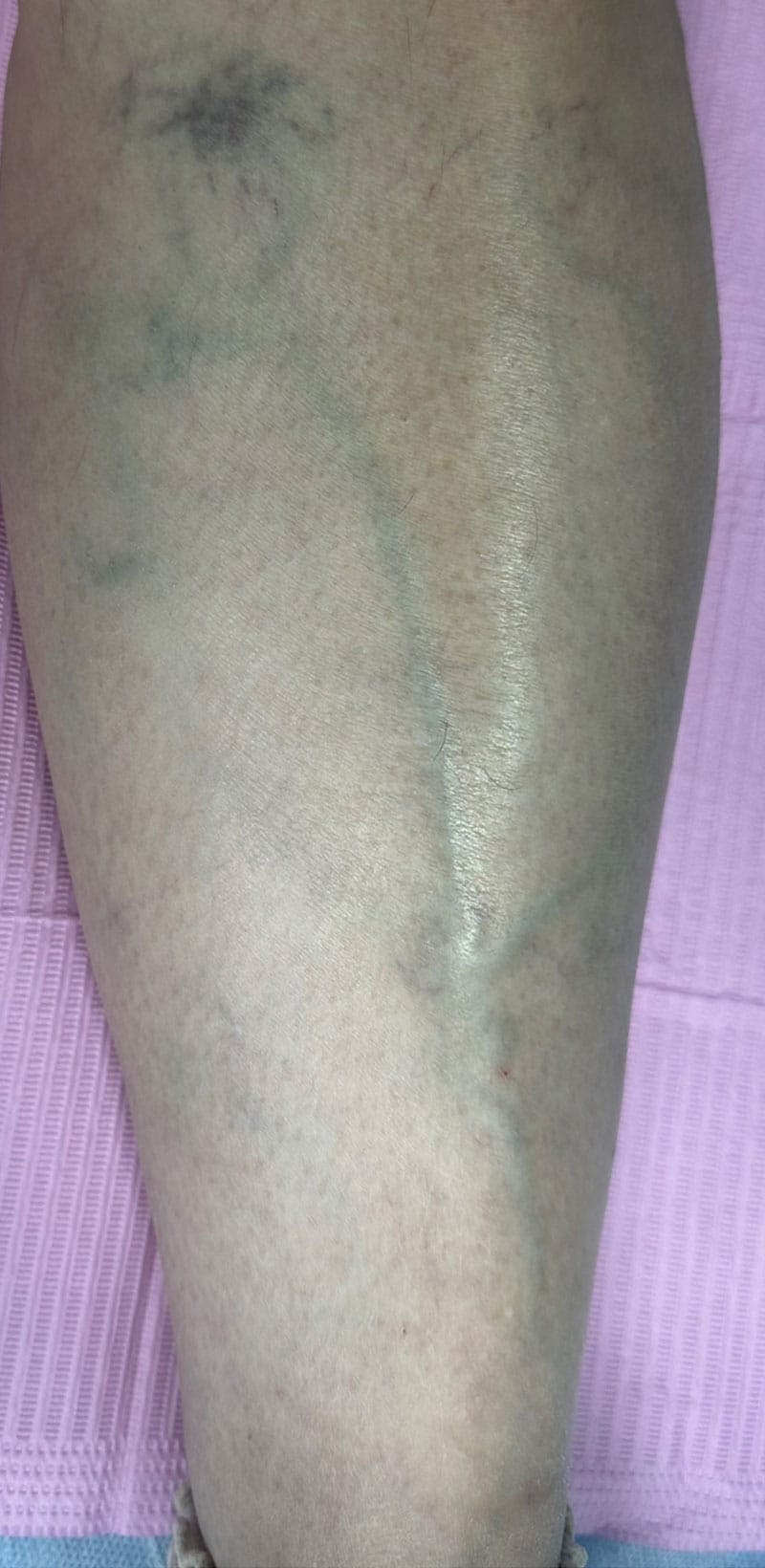 Sclerotherapy & Varithena Before & After Gallery - Patient 363631 - Image 1