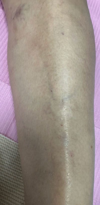 Sclerotherapy & Varithena Before & After Gallery - Patient 363631 - Image 2