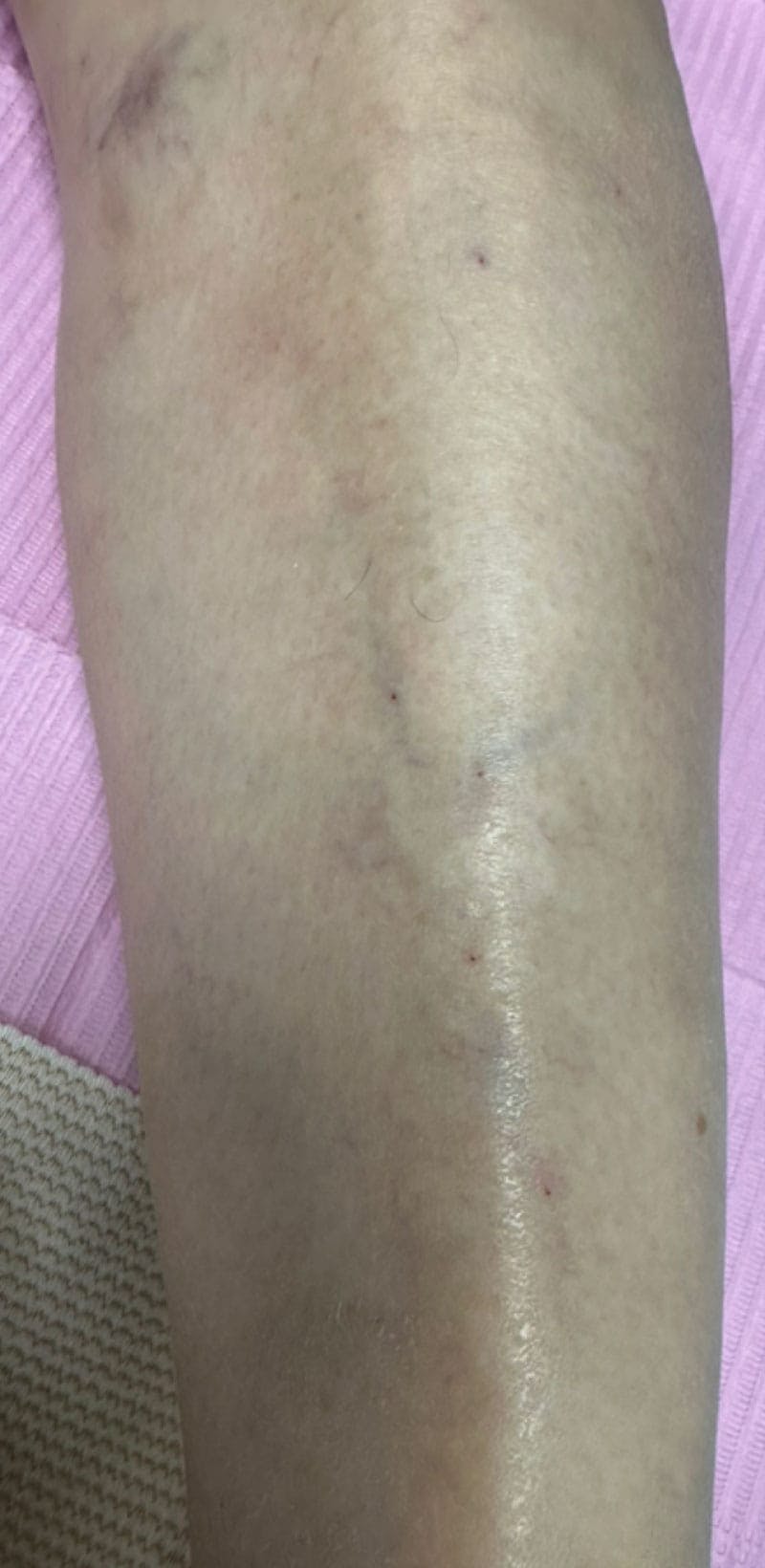 Sclerotherapy & Varithena Before & After Gallery - Patient 363631 - Image 2