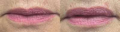 Lip Flip Before & After Gallery - Patient 163453 - Image 1
