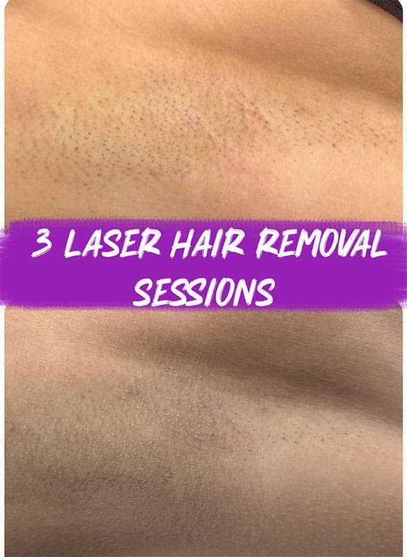 Laser Hair Removal Before & After Gallery - Patient 334381 - Image 1