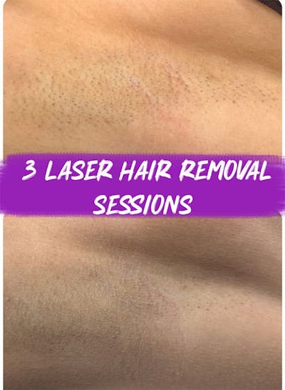 Laser Hair Removal Before & After Gallery - Patient 334381 - Image 1