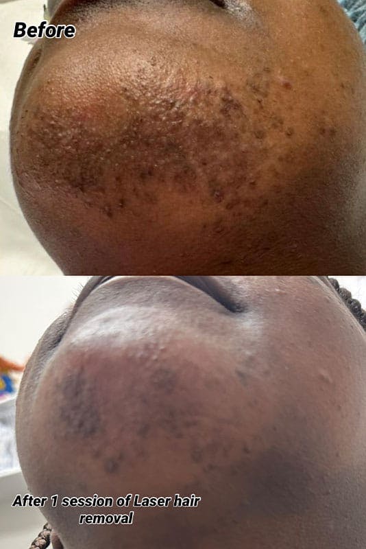 Laser Hair Removal Before & After Gallery - Patient 141783 - Image 1