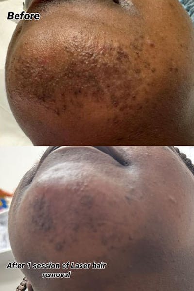 Laser Hair Removal Before & After Gallery - Patient 141783 - Image 1