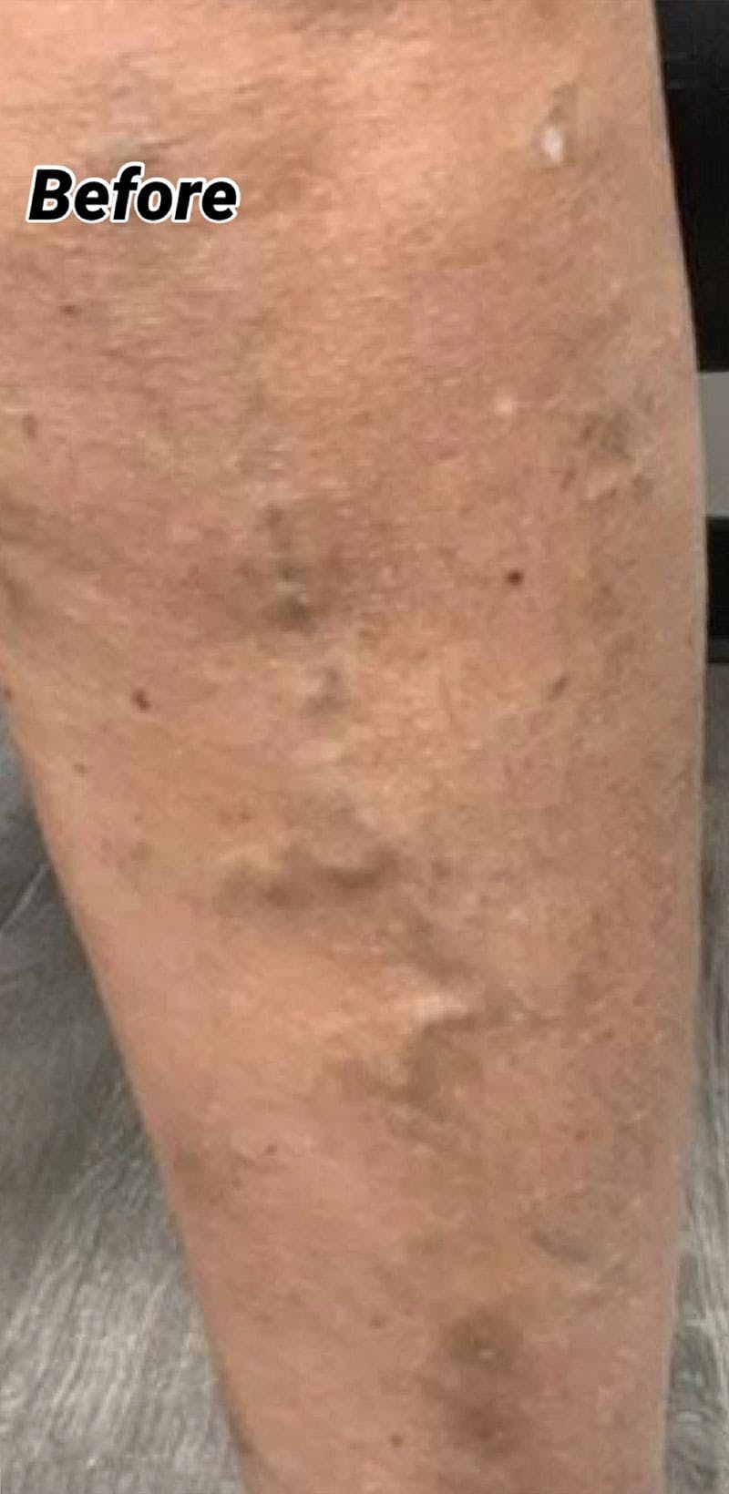 Sclerotherapy & Varithena Before & After Gallery - Patient 308102 - Image 1