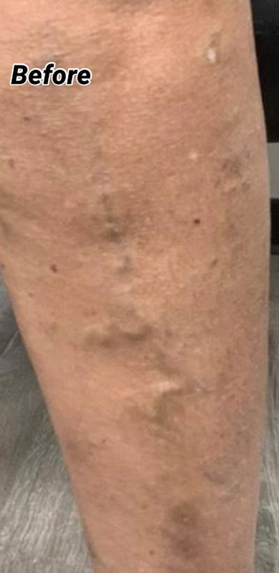 Sclerotherapy & Varithena Before & After Gallery - Patient 308102 - Image 1