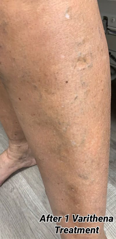 Sclerotherapy & Varithena Before & After Gallery - Patient 308102 - Image 2