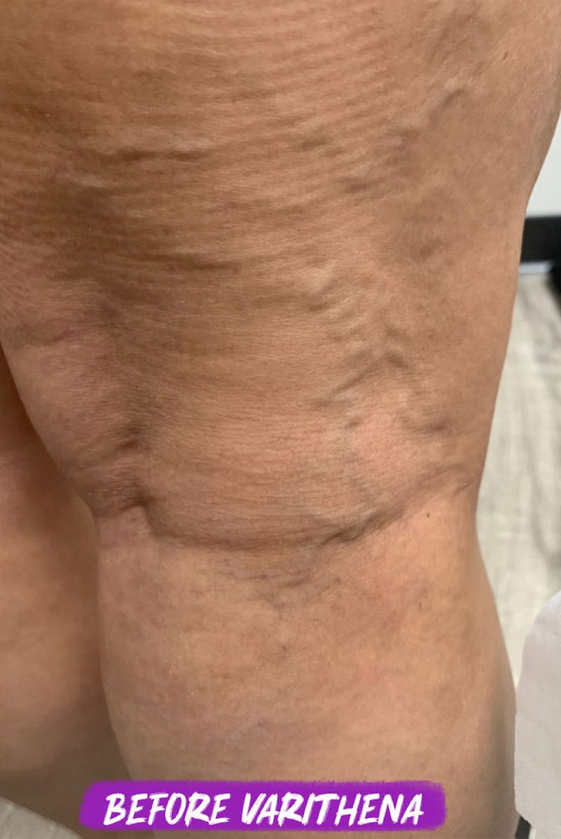 Sclerotherapy & Varithena Before & After Gallery - Patient 244607 - Image 1