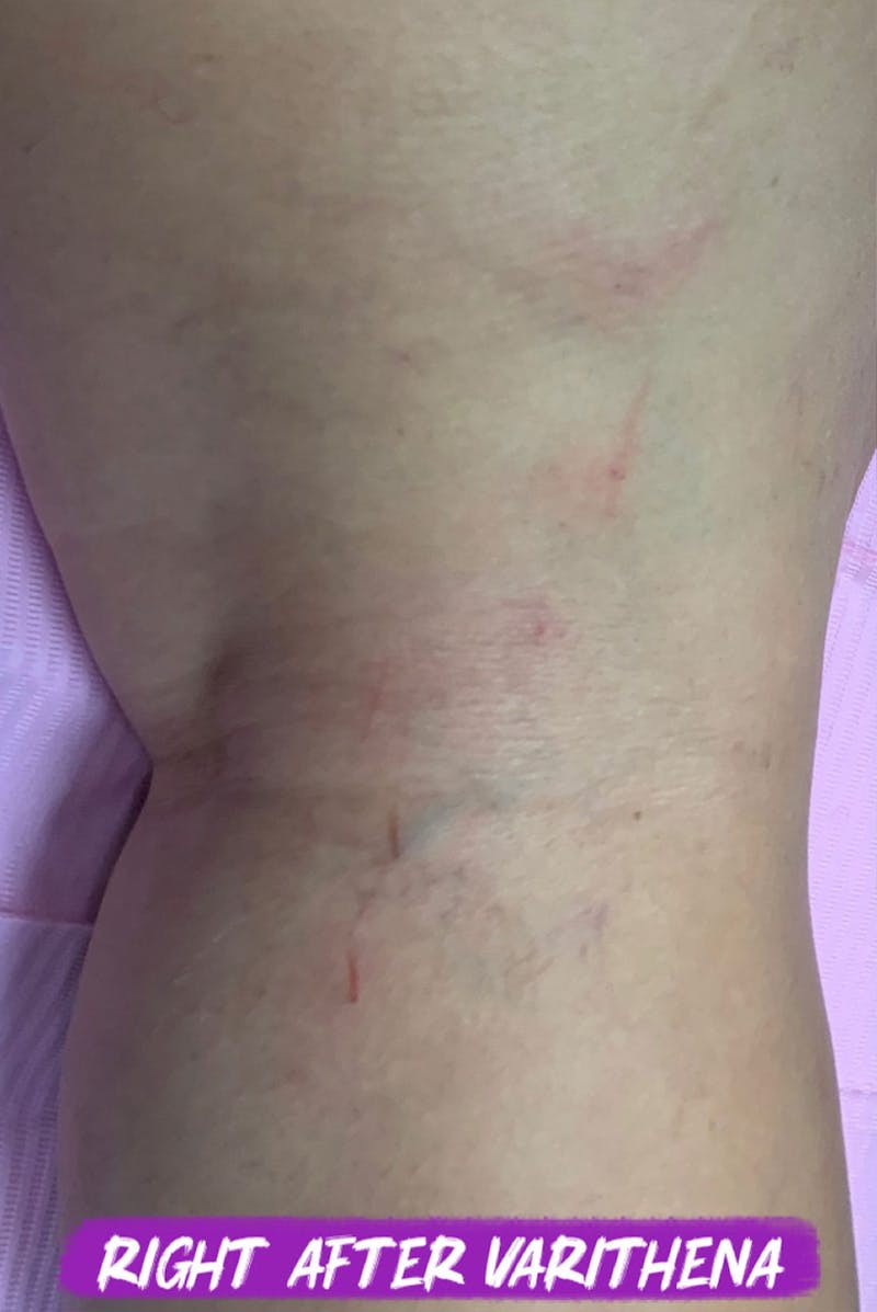 Sclerotherapy & Varithena Before & After Gallery - Patient 244607 - Image 2