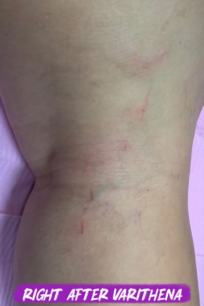 Sclerotherapy & Varithena Before & After Gallery - Patient 244607 - Image 2