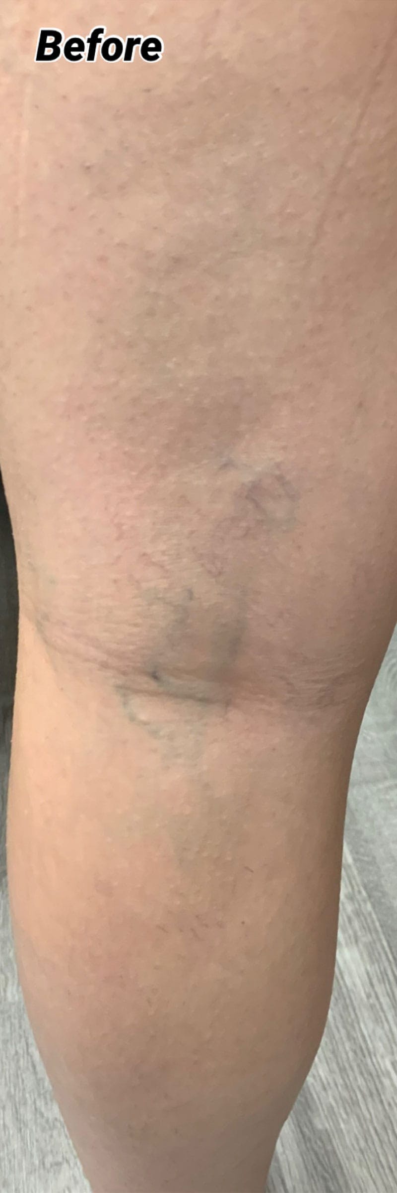 Sclerotherapy & Varithena Before & After Gallery - Patient 308788 - Image 1