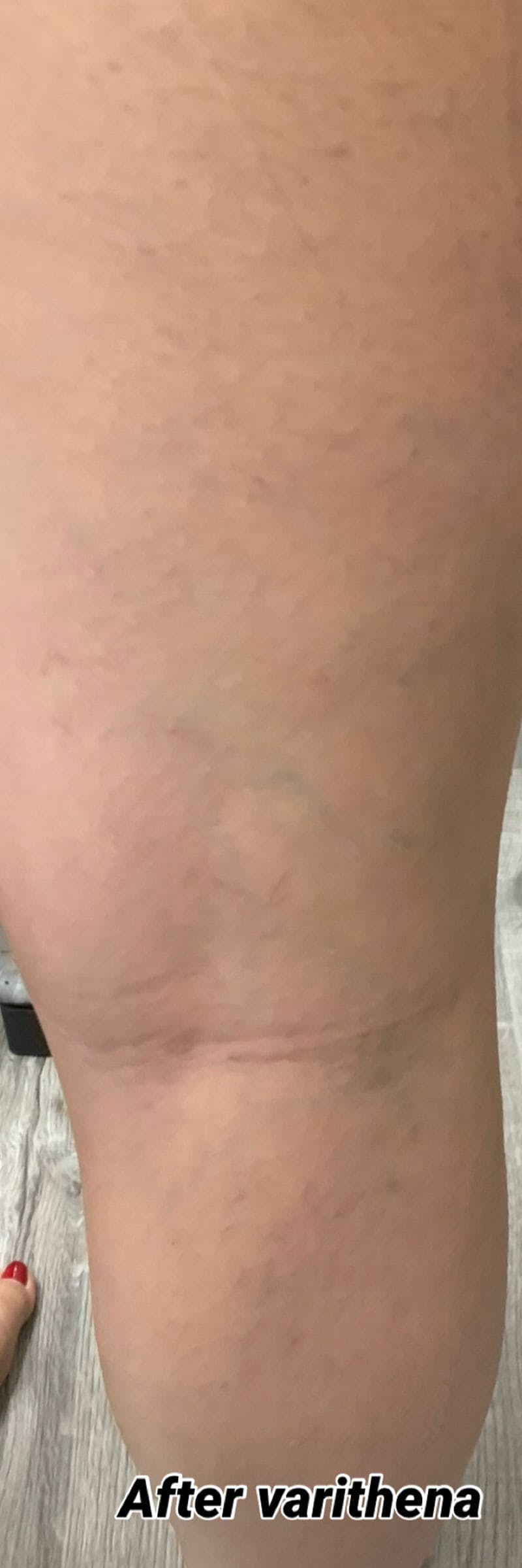 Sclerotherapy & Varithena Before & After Gallery - Patient 308788 - Image 2