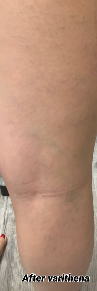 Sclerotherapy & Varithena Before & After Gallery - Patient 308788 - Image 2