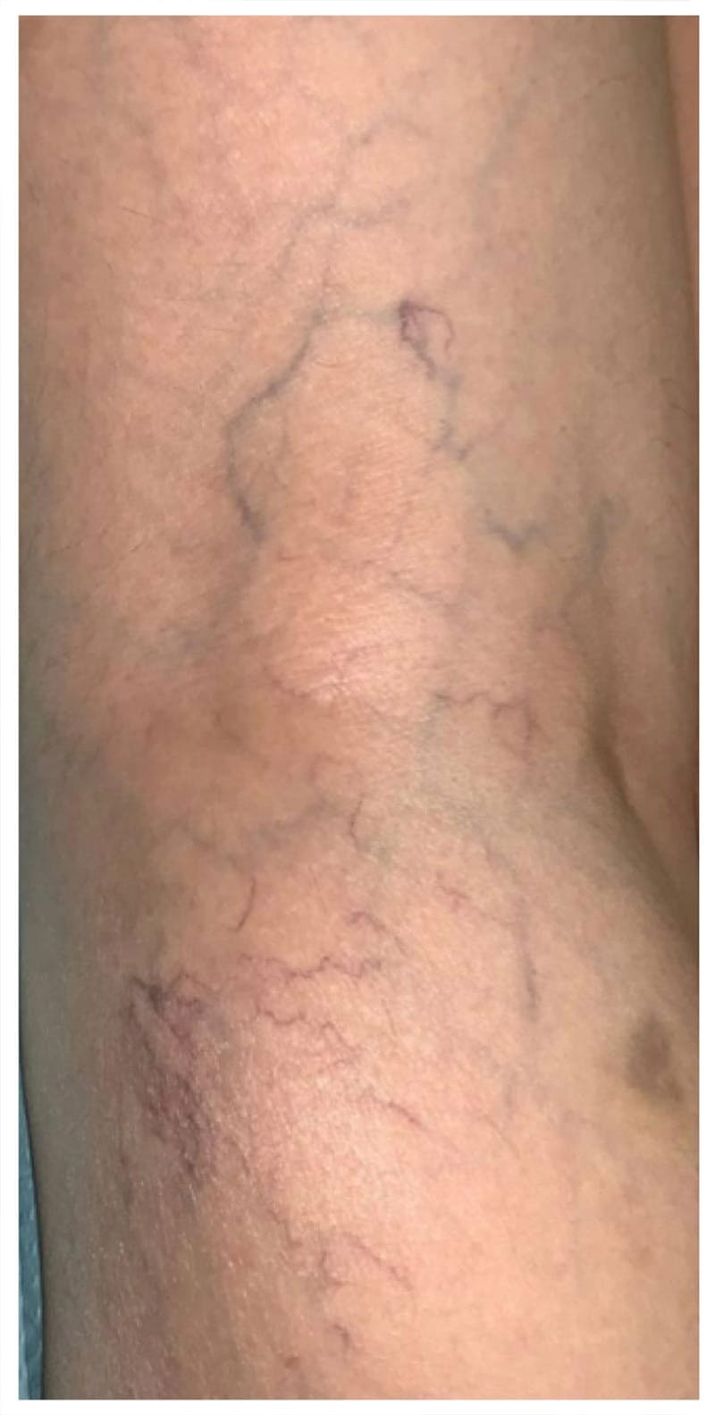 Sclerotherapy & Varithena Before & After Gallery - Patient 284026 - Image 1