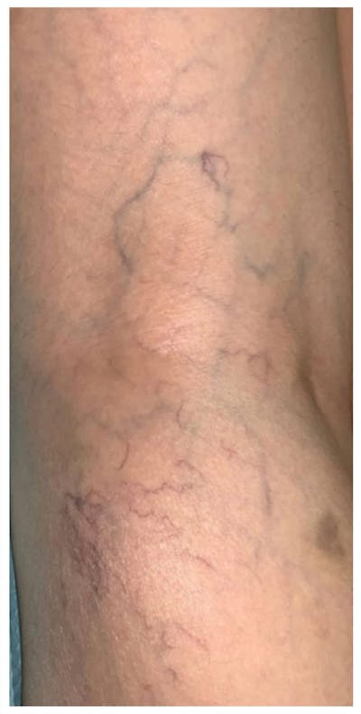 Sclerotherapy & Varithena Before & After Gallery - Patient 284026 - Image 1