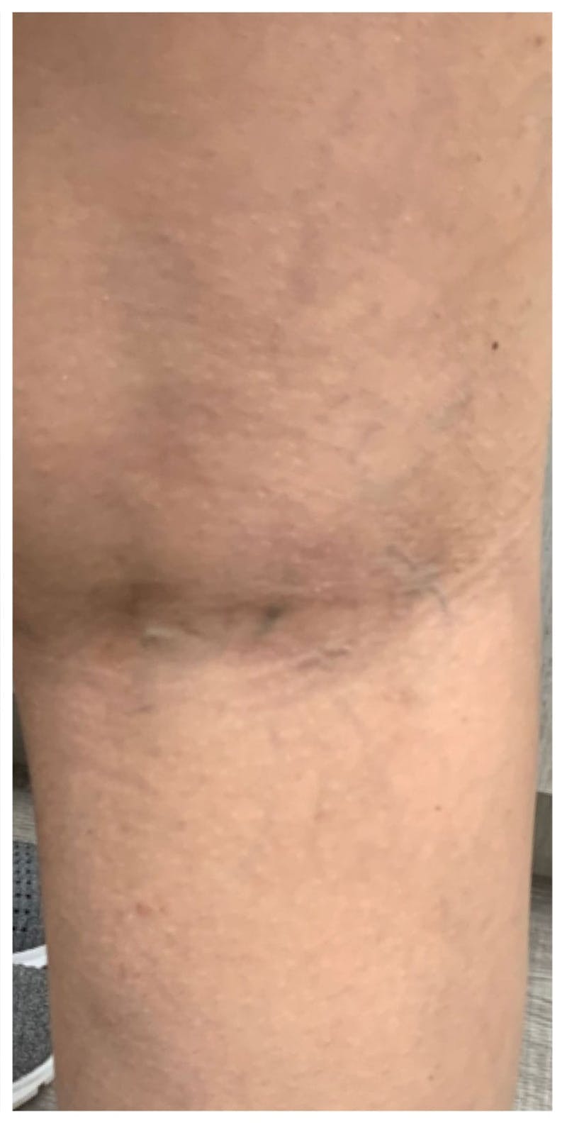 Sclerotherapy & Varithena Before & After Gallery - Patient 284026 - Image 2