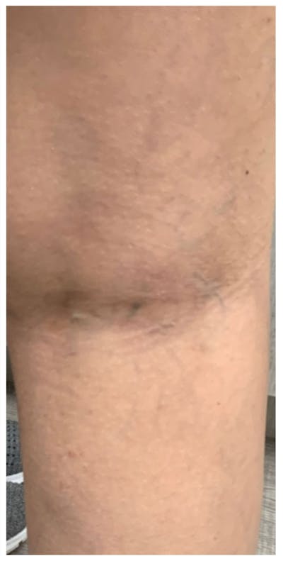 Sclerotherapy & Varithena Before & After Gallery - Patient 284026 - Image 2