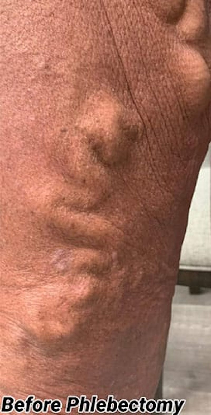 Phlebectomy Before & After Gallery - Patient 704955 - Image 1