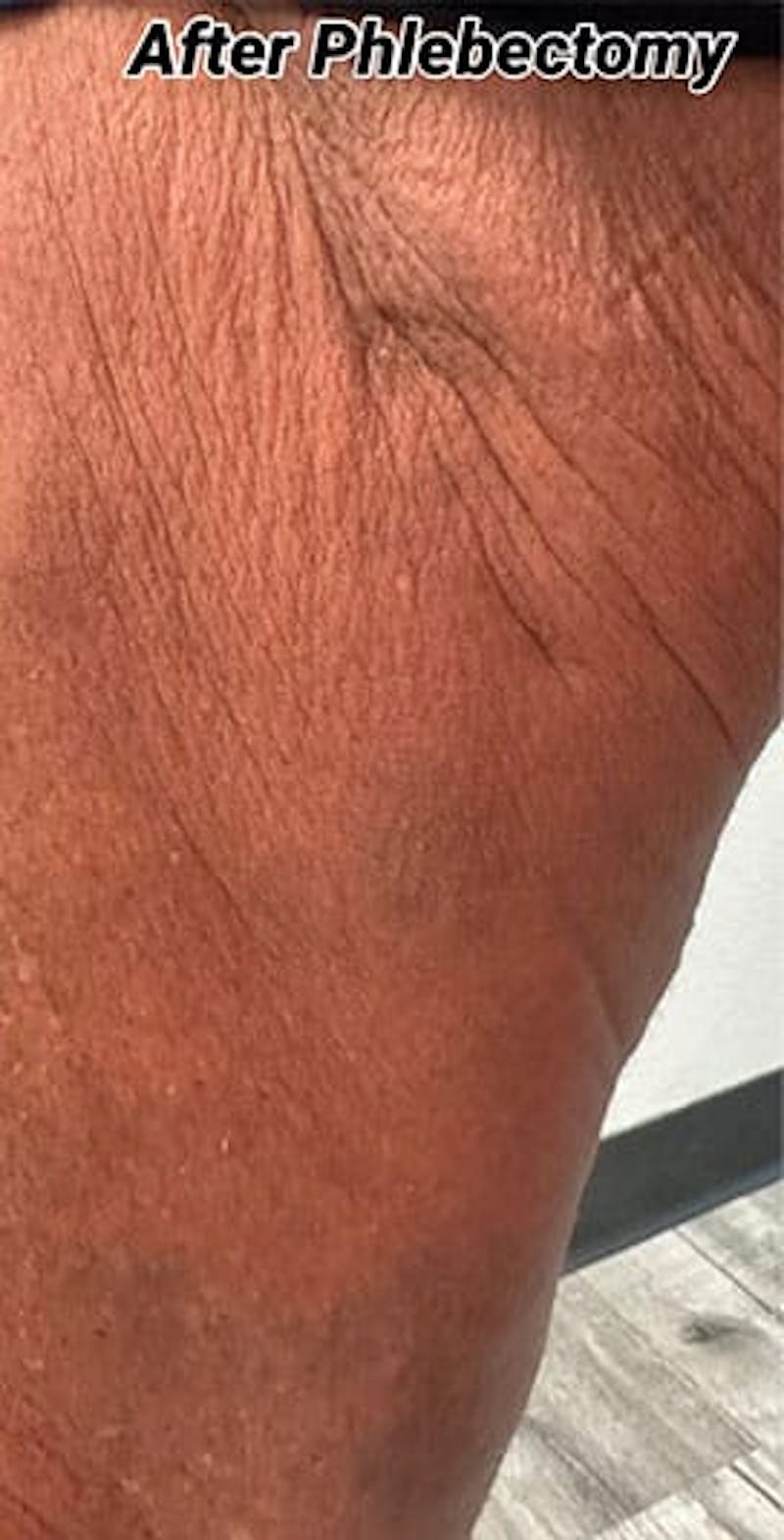 Phlebectomy Before & After Gallery - Patient 704955 - Image 2