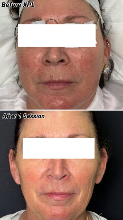 XPL Before & After Gallery - Patient 406529 - Image 1