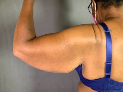 Arm Lift (Brachioplasty) Before & After Gallery - Patient 164216480 - Image 1