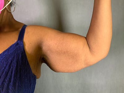 Arm Lift (Brachioplasty) Before & After Gallery - Patient 164216480 - Image 1