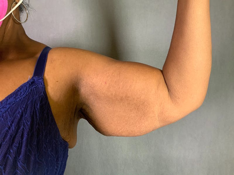 Arm Lift (Brachioplasty) Before & After Gallery - Patient 164216480 - Image 3