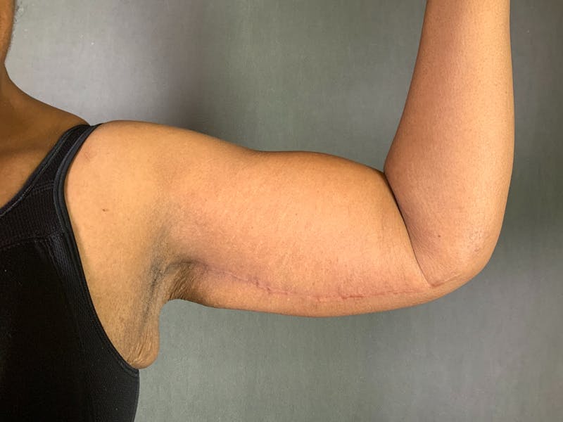 Arm Lift (Brachioplasty) Before & After Gallery - Patient 164216480 - Image 4