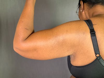 Arm Lift (Brachioplasty) Before & After Gallery - Patient 164216480 - Image 2