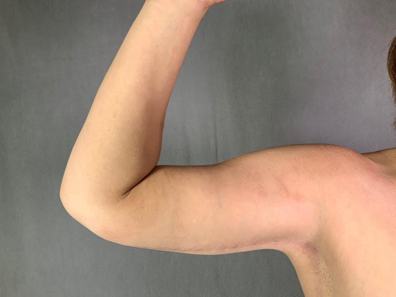 Arm Lift (Brachioplasty) Before & After Gallery - Patient 164216516 - Image 4